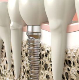 Implant zębowy