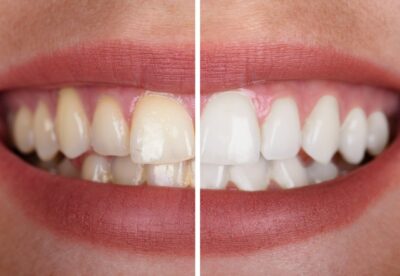 zęby przed i po wybielaniu
