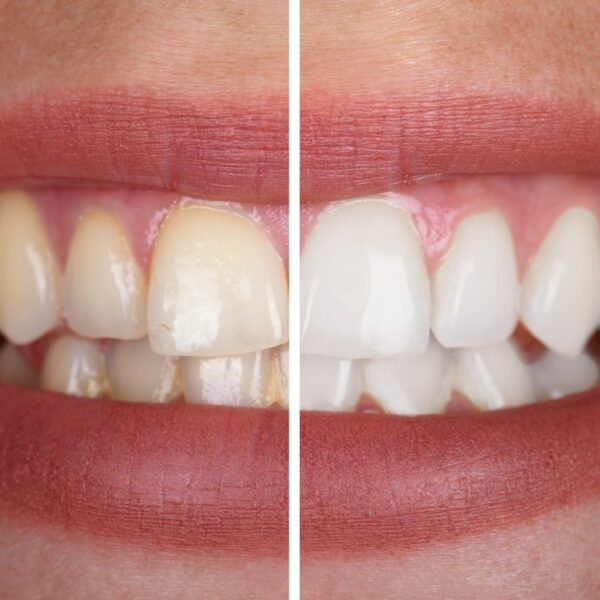 zęby przed i po wybielaniu